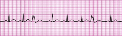 Demystifying ventricular arrhythmias