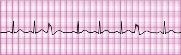 Demystifying ventricular arrhythmias