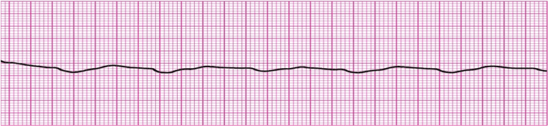 Demystifying ventricular arrhythmias