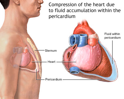 Acute cardiac tamponade
