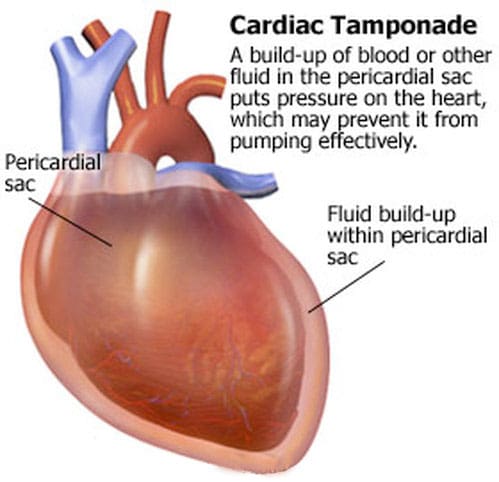 Acute cardiac tamponade