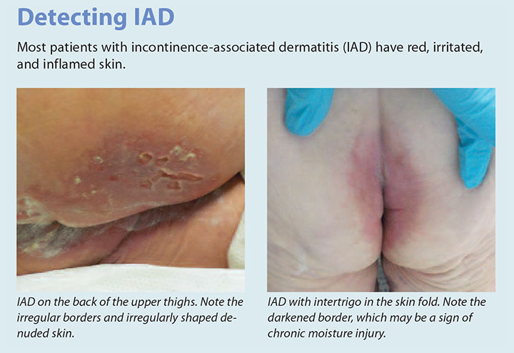 incontinence associated dermatitis management update