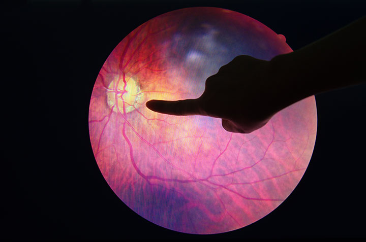 detect diabetic retinopathy