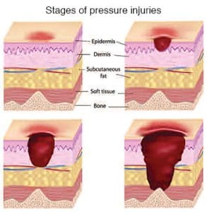 Critical care of the skin - American Nurse Today