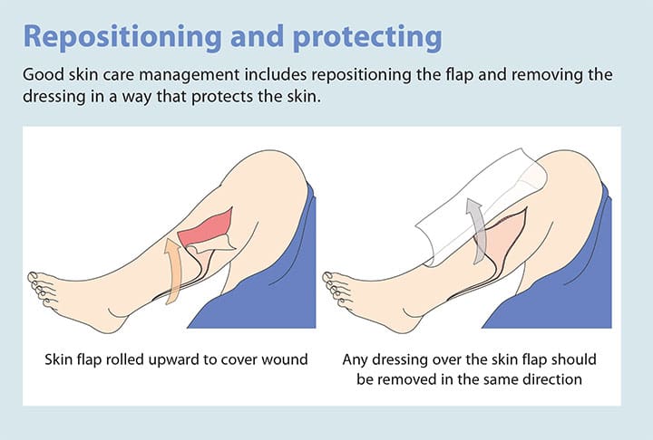 tear assessment management prevention repositioning protection