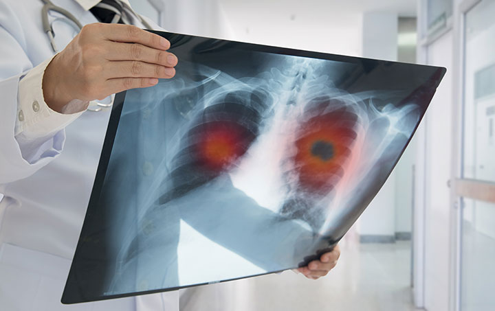 lung cancer mortality women increase