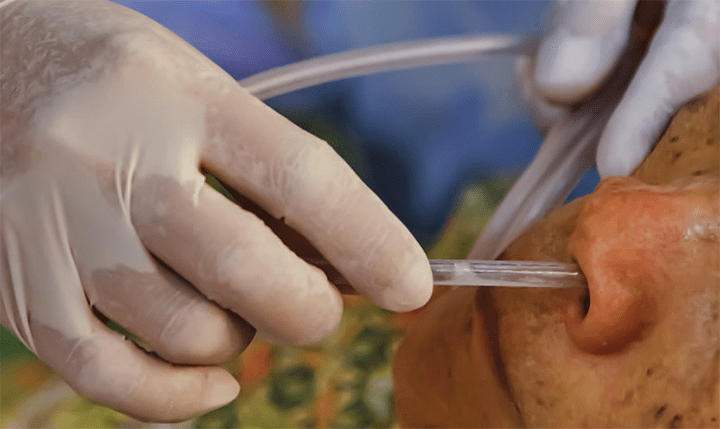 reducing nasogastric tube misplacement