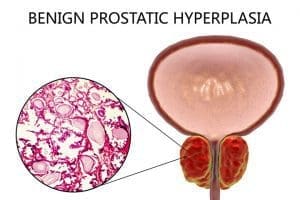 benign-prostatic-hyperplasia-resized
