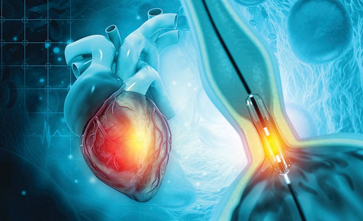 preventing radial artery occlusion