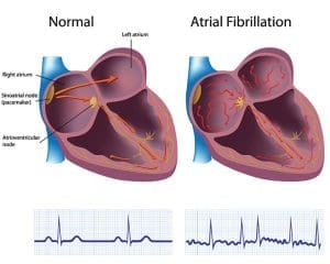 Normal-conduction-vs-atrial-fibrillation