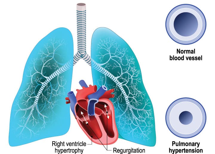 pulmonary hypertension