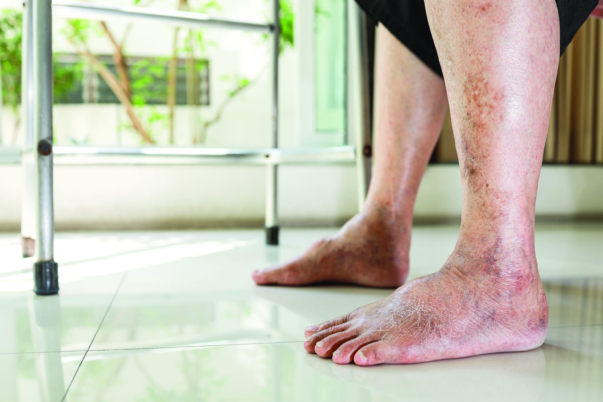 Diabetic foot ulcers in ambulatory settings